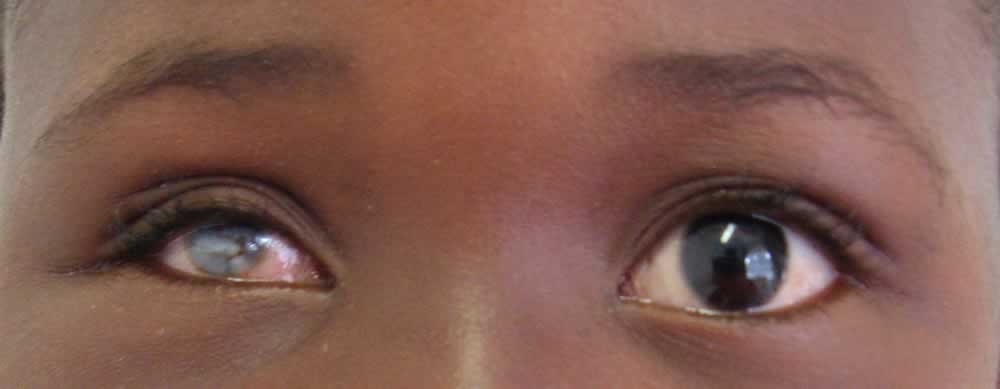 Phthisical Eye - Eyes Alive