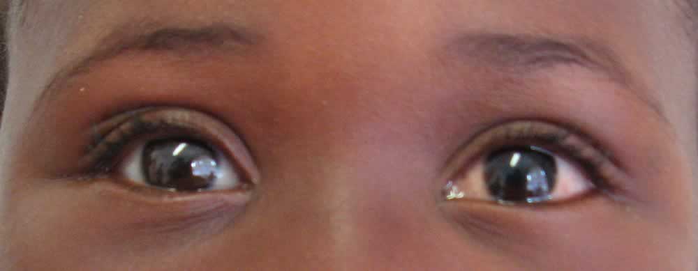 Phthisical Eye - Eyes Alive